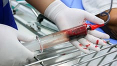 Apixaban Again Tied to Lower GI Bleeding vs Other DOACs in Atrial Fibrillation