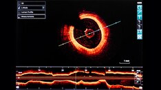 Should Intravascular Imaging Be Almost Routine in PCI?
