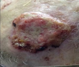 Deadly Skin Cancers