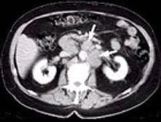 ss-advanced-prostate-cancer