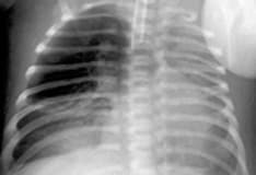 Pulmonary Sequestration Imaging: Overview, Radiography, Computed Tomography