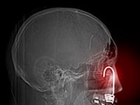 Foreign Bodies: Curious Findings