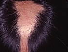Not-to-Miss Diseases Presenting as Hair Loss