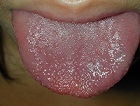Kawasaki Disease: Do You Know the Signs?