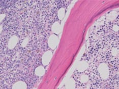 ss-myelodysplastic-syndromes