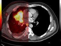 Non-Small Cell Lung Cancer: 5 Management Challenges