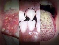 Clues in the Oral Cavity: Are You Missing the Diagnosis?