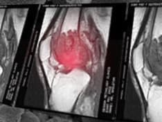 ss-osteomyelitis