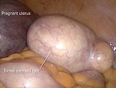 ss-ovarian-cysts