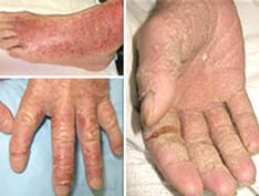ss-psoriasis-subtypes