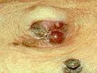 Clues on the Skin: Systemic Gastrointestinal Diseases