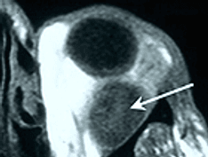 ss-transplant-patient