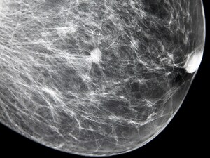 Novel Combo Boosts Response in HER2– Breast Cancer