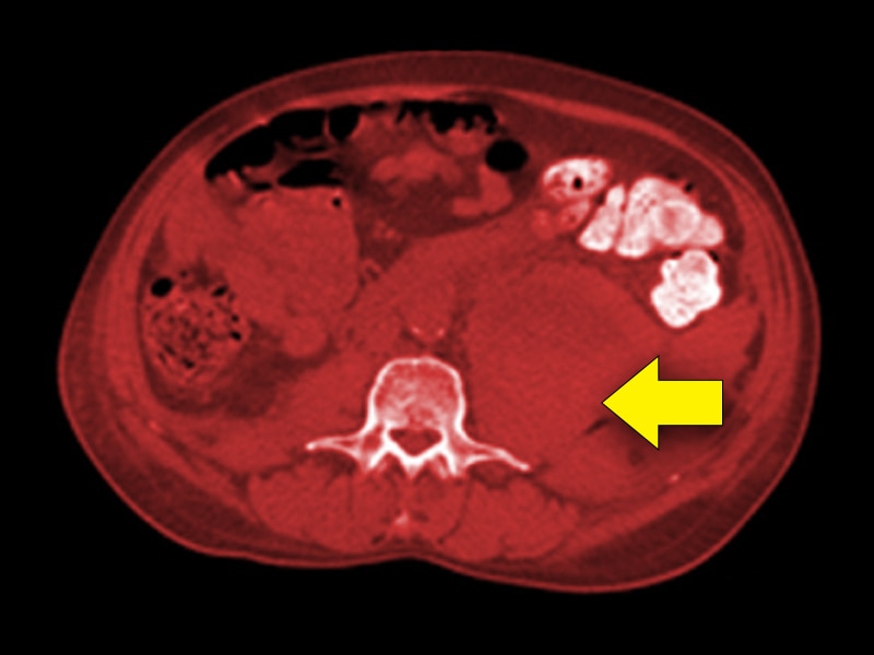 Acquired Hemophilia: Control the Bleeding, Eliminate the Inhibitor