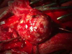 ss-adult-brain-tumors