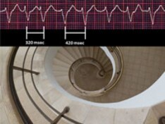 ss-arrhythmogenic-syncope