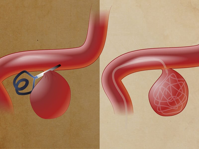 Cerebrovascular Accident: A Stroke of Misfortune