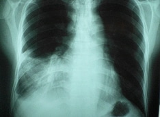 Chest Pain: Cardiac and Noncardiac Causes