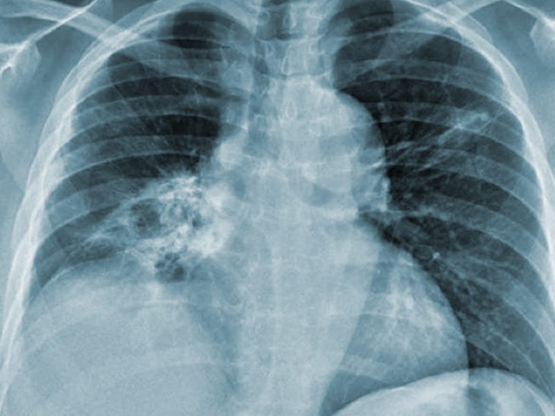 Chest XRays 16 Subtle But Key Findings You Need to Know