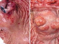 Colorectal Cancer: Prevention, Diagnosis, and Therapeutic Options