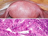 Endometrial Cancer: Common but Predominantly Curable