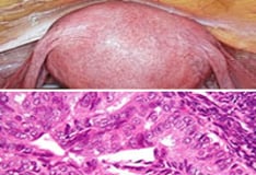 endometrium rák jco