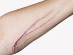 ss-fever-unknown-origin