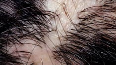 Hair Disorders: Finding the Root of the Problem