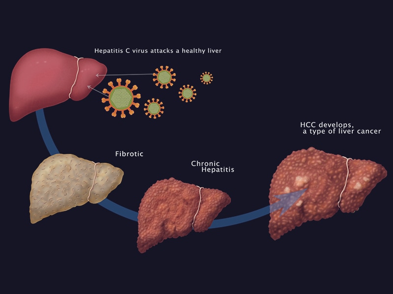 Hepatitis C: Cure Is About More Than the Liver