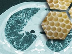 ss-idiopathic-pulmonary-fibrosis