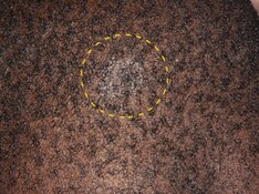 Identifying Lesions on Skin of Color