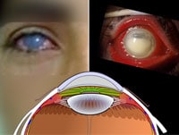 Ocular Trauma: 8 Potentially Devastating Eye Injuries