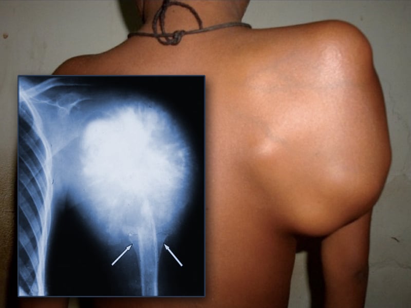 Osteosarcoma, Chondrosarcoma, and Ewing Sarcoma: Bred in the Bone