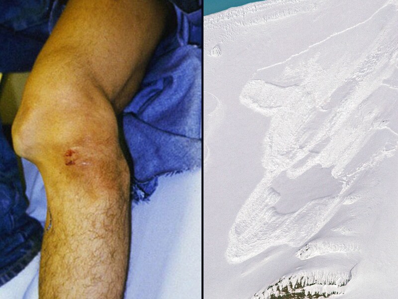 Snow Encounters: Avalanches and Skiing/Snowboarding Injuries