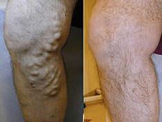 ss-superficial-venous-insufficiency