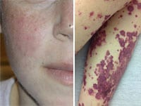 Systemic Lupus Erythematosus: Diverse and Difficult to Diagnose