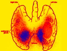 ss-thyroid-cancer