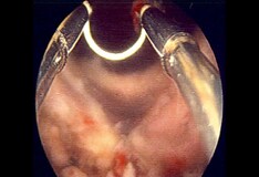 Pdf The Physical And Antimicrobial Effects Of Microwave Heating And Alcohol Immersion On Catheters That Are Reused For Clean Intermittent Catheterisation