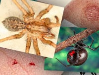 Venomous Spider Bites: Keys to Diagnosis and Treatment