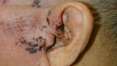 Cutaneous and Mucosal Manifestations of Viral Diseases