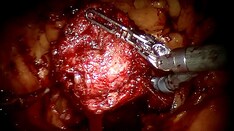 Urinary Incontinence: Not Just a Flow Issue