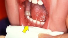 Back-to-School Viral Illnesses: Classroom Contagions in 2022