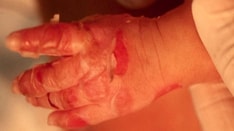 6 Common-to-Rare Infant Skin Conditions