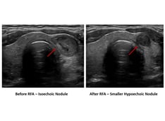 Shrinking Thyroid Nodules with Radiofrequency Ablation