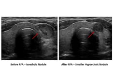 speech recognition threshold definition Shrinking Thyroid Nodules with Radiofrequency Ablation