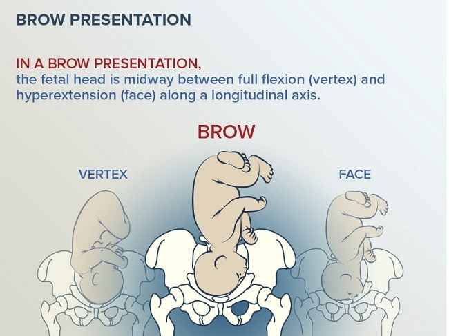 the presenting diameter in brow presentation