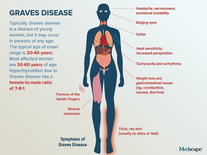 Graves39 Disease Symptoms Specific Causes And Current