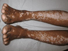 Response to Narrow-band UVB – Vitiligo-melasma versus Vitiligo