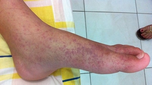 10 Travel Diseases You Need to Know