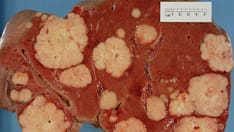 Pancreatic Cancer: Difficult Diagnosis, Ominous Outlook